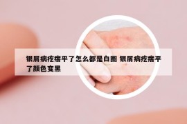 銀屑病疙瘩平了怎么都是白圈 銀屑病疙瘩平了顏色變黑