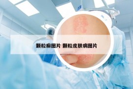 顆粒癬圖片 顆粒皮膚病圖片