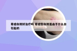 暈痣白斑好治療嗎 暈痣型白斑是由于什么會引起的