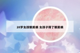 20歲女孩銀屑病 女孩子得了銀屑病