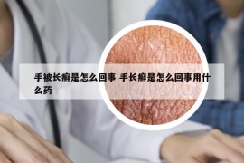 手被長(zhǎng)癬是怎么回事 手長(zhǎng)癬是怎么回事用什么藥