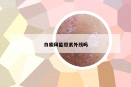 白癜風能照紫外線嗎