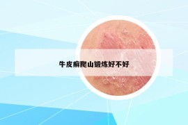 牛皮癬爬山鍛煉好不好