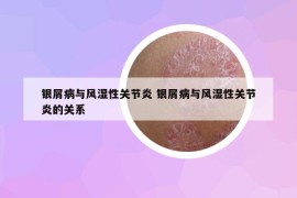 銀屑病與風濕性關(guān)節(jié)炎 銀屑病與風濕性關(guān)節(jié)炎的關(guān)系