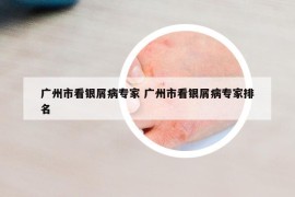 廣州市看銀屑病專家 廣州市看銀屑病專家排名
