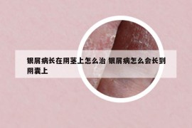 銀屑病長在陰莖上怎么治 銀屑病怎么會長到陰囊上