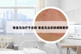 秦皇島治療牛皮癬 秦皇島治皮膚病哪里好