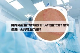 國內(nèi)目前治療銀宵病打什么針劑療效好 銀宵病用什么藥物治療最好