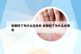 皮癬好了為什么還會長 皮癬好了為什么會變白