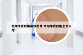 初期牛皮膚癬癥狀圖片 早期牛皮膚癬怎么治療