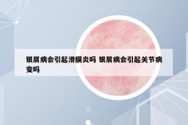 銀屑病會引起滑膜炎嗎 銀屑病會引起關節(jié)病變嗎