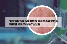 銀屑病打修美樂能治根嗎 銀屑病患者使用生物制劑 修美樂的治療全過程