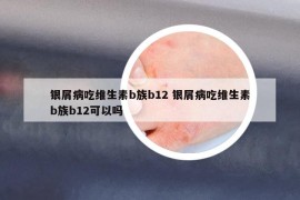 銀屑病吃維生素b族b12 銀屑病吃維生素b族b12可以嗎