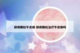 膚癢顆粒牛皮癬 膚癢顆粒治療牛皮癬嗎