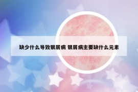 缺少什么導(dǎo)致銀屑病 銀屑病主要缺什么元素