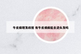 牛皮癬理發(fā)歧視 有牛皮病癬能去燙頭發(fā)嗎