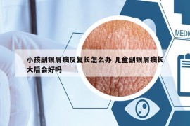 小孩副銀屑病反復(fù)長(zhǎng)怎么辦 兒童副銀屑病長(zhǎng)大后會(huì)好嗎