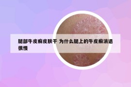 腿部牛皮癬皮膚干 為什么腿上的牛皮癬消退很慢