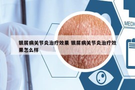 銀屑病關(guān)節(jié)炎治療效果 銀屑病關(guān)節(jié)炎治療效果怎么樣