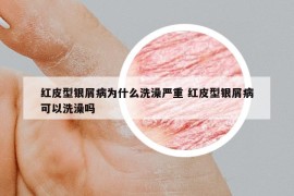紅皮型銀屑病為什么洗澡嚴重 紅皮型銀屑病可以洗澡嗎