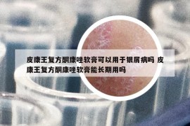 皮康王復(fù)方酮康唑軟膏可以用于銀屑病嗎 皮康王復(fù)方酮康唑軟膏能長期用嗎