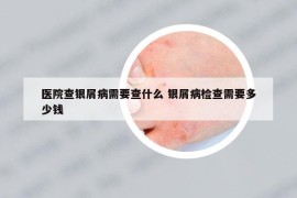 醫(yī)院查銀屑病需要查什么 銀屑病檢查需要多少錢