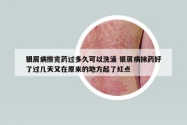 銀屑病擦完藥過多久可以洗澡 銀屑病抹藥好了過幾天又在原來的地方起了紅點(diǎn)