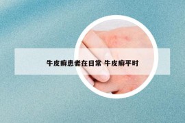 牛皮癬患者在日常 牛皮癬平時