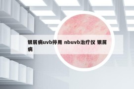 銀屑病uvb停用 nbuvb治療儀 銀屑病
