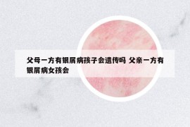 父母一方有銀屑病孩子會遺傳嗎 父親一方有銀屑病女孩會
