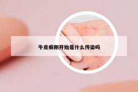 牛皮癬剛開(kāi)始是什么傳染嗎