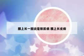 腰上長一圈說是銀屑病 腰上長皮癬
