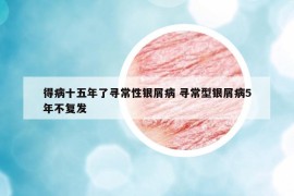 得病十五年了尋常性銀屑病 尋常型銀屑病5年不復(fù)發(fā)