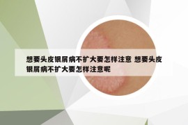 想要頭皮銀屑病不擴大要怎樣注意 想要頭皮銀屑病不擴大要怎樣注意呢