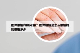 醫(yī)保報銷白癜風治療 醫(yī)保報銷是怎么報銷的能報銷多少