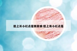 臉上長小紅點是銀屑病 臉上有小紅點是