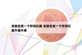 皮膚出現(xiàn)一個環(huán)狀紅圈 皮膚出現(xiàn)一個環(huán)狀紅圈不痛不癢
