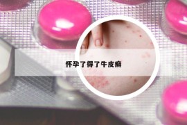 懷孕了得了牛皮癬