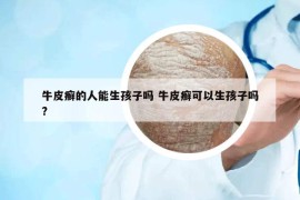 牛皮癬的人能生孩子嗎 牛皮癬可以生孩子嗎?