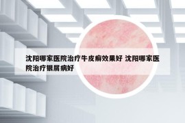 沈陽哪家醫(yī)院治療牛皮癬效果好 沈陽哪家醫(yī)院治療銀屑病好