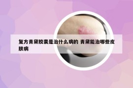 復(fù)方青黛膠囊是治什么病的 青黛能治哪些皮膚病