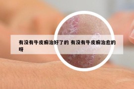 有沒有牛皮癬治好了的 有沒有牛皮癬治愈的呀