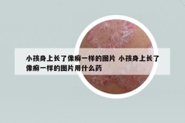 小孩身上長了像癬一樣的圖片 小孩身上長了像癬一樣的圖片用什么藥