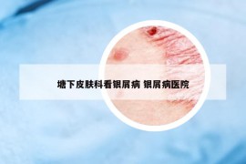 塘下皮膚科看銀屑病 銀屑病醫(yī)院