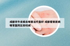 成都市牛皮癬去哪里治療最好 成都看銀屑病哪家醫(yī)院比較權(quán)威