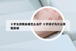 十歲女孩銀血病怎么治療 十歲孩子為什么得銀屑病