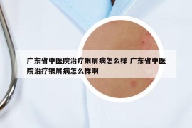 廣東省中醫(yī)院治療銀屑病怎么樣 廣東省中醫(yī)院治療銀屑病怎么樣啊