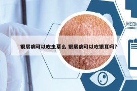 銀屑病可以吃蟲草么 銀屑病可以吃銀耳嗎?