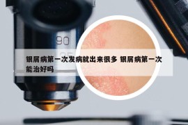 銀屑病第一次發(fā)病就出來很多 銀屑病第一次能治好嗎