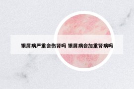 銀屑病嚴(yán)重會傷腎嗎 銀屑病會加重腎病嗎